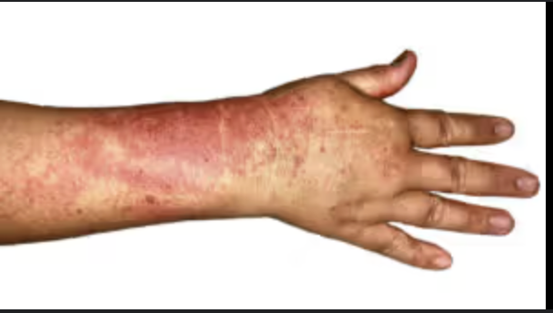 <ul><li><p>Eosinofilia periférica (en sangre &gt;500/L)</p></li><li><p>Púrpura cutánea</p></li><li><p>Mononeuritis (entumecimiento, dolor, homigueo)</p></li><li><p>Rinitis alérgica</p></li><li><p>Derrames pleurales exudativos con eosinofilia</p></li></ul><p></p>