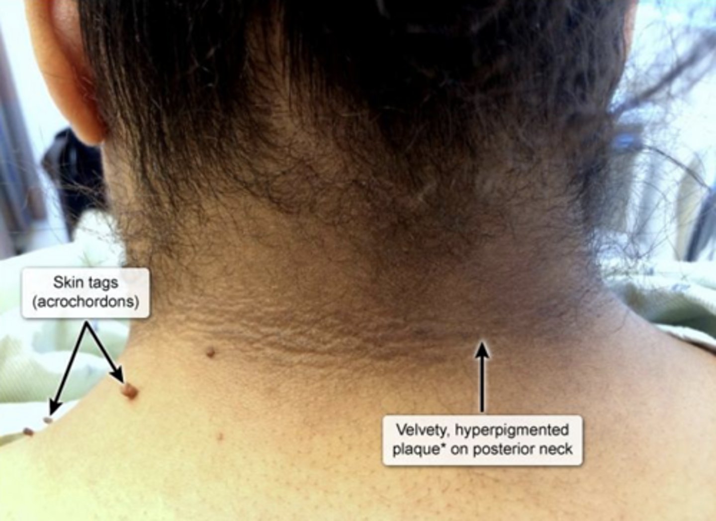 <p>central obesity, hypertension, acanthosis nigricans and skin tags</p>