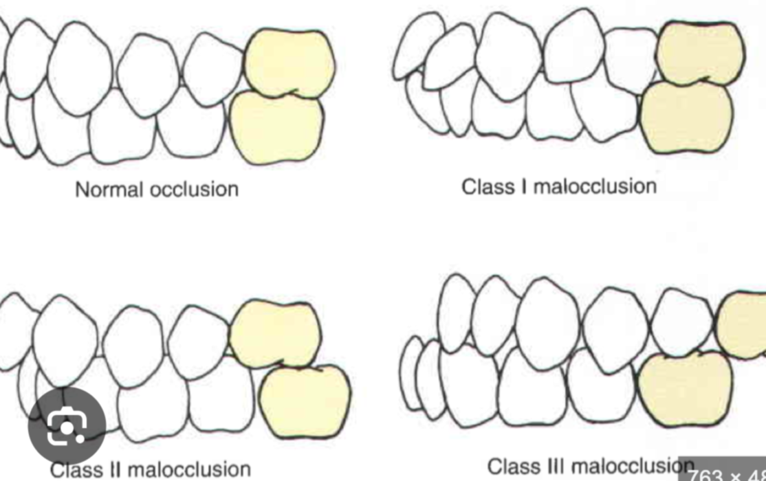 <ul><li><p><strong>Class II malocclusion (overbite)</strong>: Mandibular teeth are posterior to their normal position relative to maxillary teeth; affects all teeth, including molars.</p><ul><li><p><strong>Class II Division 1</strong>: Significant overjet (large horizontal overlap of maxillary incisors).</p></li><li><p><strong>Class II Division 2</strong>: Overbite with lateral flaring of lateral maxillary incisors, but no significant overjet.</p></li></ul></li></ul><p></p>