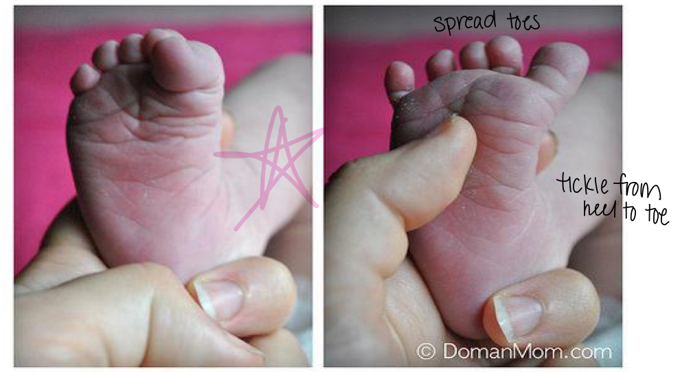 <p><span>a normal, primitive reflex in infants where the big toe moves upward (dorsiflexion) and the other toes fan out when the sole of the foot is stroked</span></p>