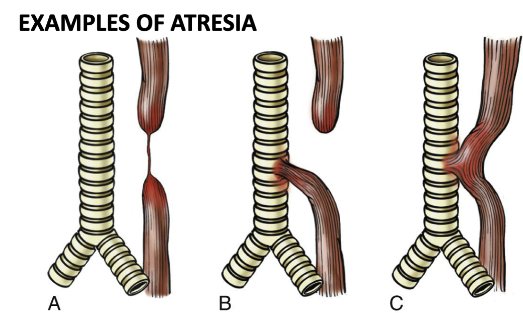 <ul><li><p>birth defect where <strong>thin, non-canalized cord replaces part of esophagus</strong> usually near tracheal bifurcation →<strong> aspiration, suffocation, pneumonia</strong></p></li><li><p>associated w/ <strong>fistula-connects esophageal pouch</strong> to bronchus or trachea</p></li></ul><p></p>