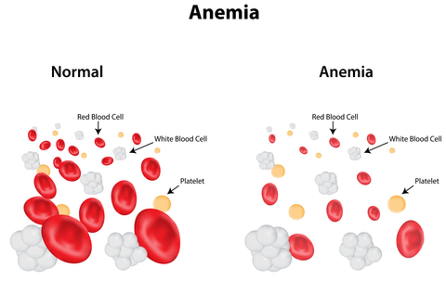 <p>anemia</p>
