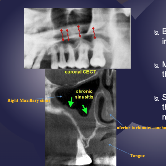 <p>sclerotic changes in boney walls&nbsp;</p>
