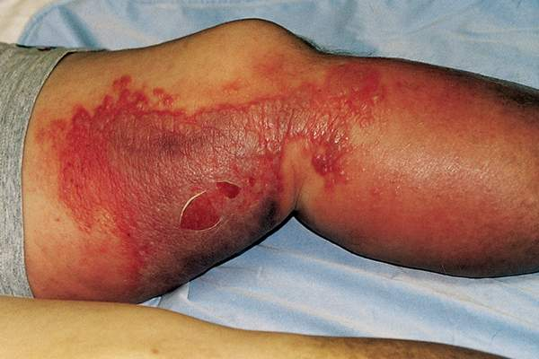 <ul><li><p><span style="line-height: inherit;">Cellulitis is an acute bacterial infection that involves the subcutaneous tissue and manifests as redness, tenderness, swelling, and warmth at the site</span></p></li><li><p><span style="line-height: inherit;">Treatment includes oral antibiotics. In some cases, patients are hospitalized and may receive IV antibiotics<br></span></p></li></ul><p></p>