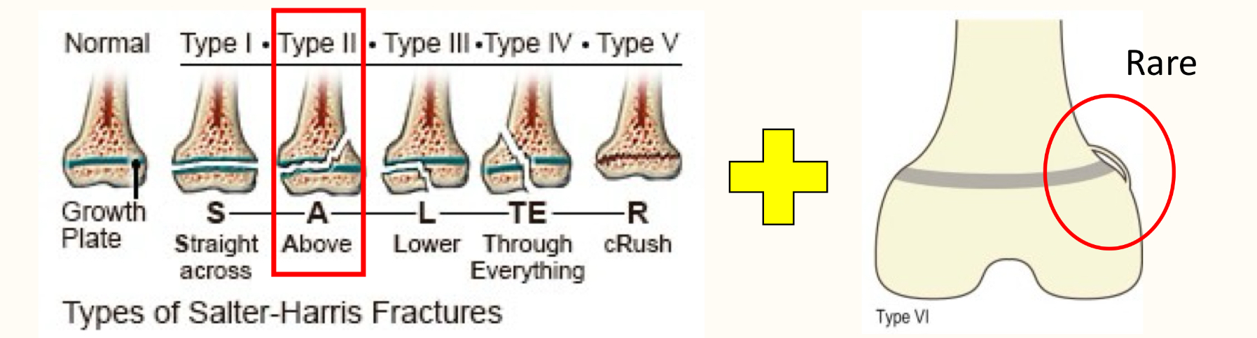 <p>fractures of physis</p>