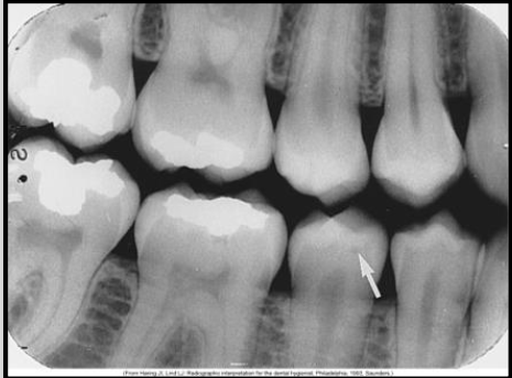 <p>Classify this carious lesion.</p>