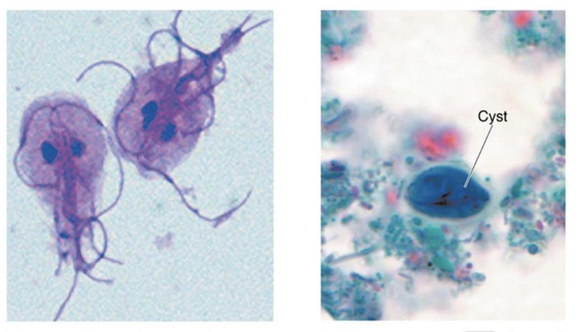 <ul><li><p>digestive protozoal disease</p></li><li><p>cause: <em>Giardia duodenalis</em></p><ul><li><p>virulence: adherence to bowel walls (trophozoite); chlorination resistance</p></li></ul></li><li><p>transmission: ingestion of cysts from contaminated water, food, or hands</p></li><li><p>symptoms: severe diarrhea (foul and greasy) → interrupts normal absorption</p></li><li><p>treatment/prevention: boiling, filtration, and good hygiene</p></li></ul><p></p>