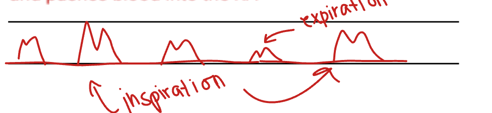 <p>The inspirations when the TV opens are much taller and brighter. The expirations are smaller and darker. This is because when you breathe in, more blood goes into the right heart because the diaphragm goes down, which increases in intra-abdominal pressure in the cavity. This causes the IVS to collapse and pushes blood into the RA.</p>