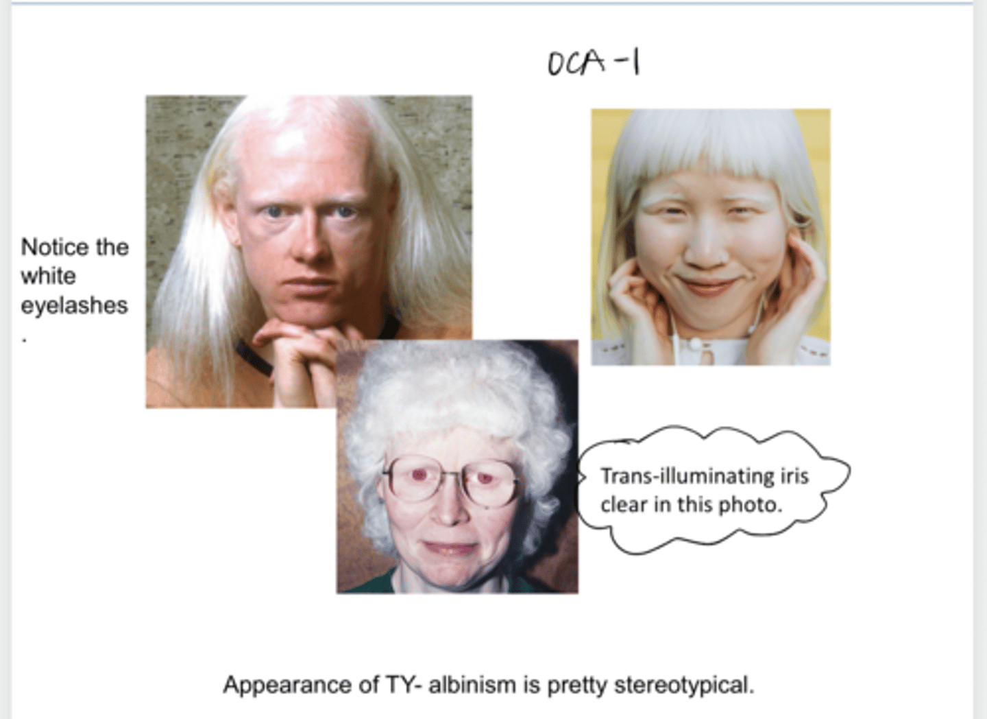 <p>Albinism phenotypes often show what?</p>