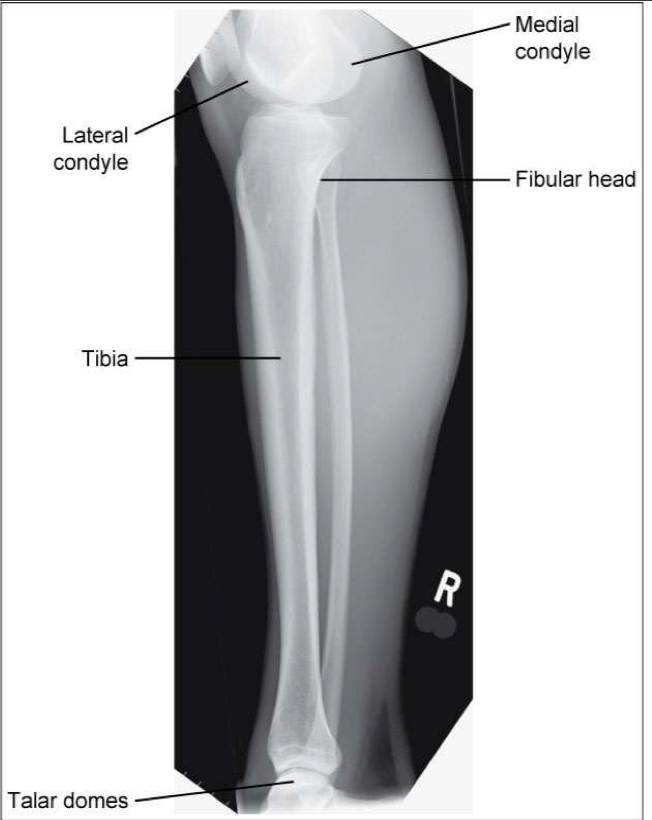 <p><span style="line-height: normal;"><span>• </span></span>Entire tibia and fibula demonstrated</p><p class="p1"><span style="line-height: normal;"><span>• </span></span>Knee and ankle joints demonstrated</p><p class="p1"><span style="line-height: normal;"><span>• </span></span>Proximal head of fibula superimposed by tibia</p><p class="p1"><span style="line-height: normal;"><span>• </span></span>Distal fibula superimposed over posterior half of tibia</p><p class="p1"><span style="line-height: normal;"><span>• </span></span>Optimal exposure factors</p>