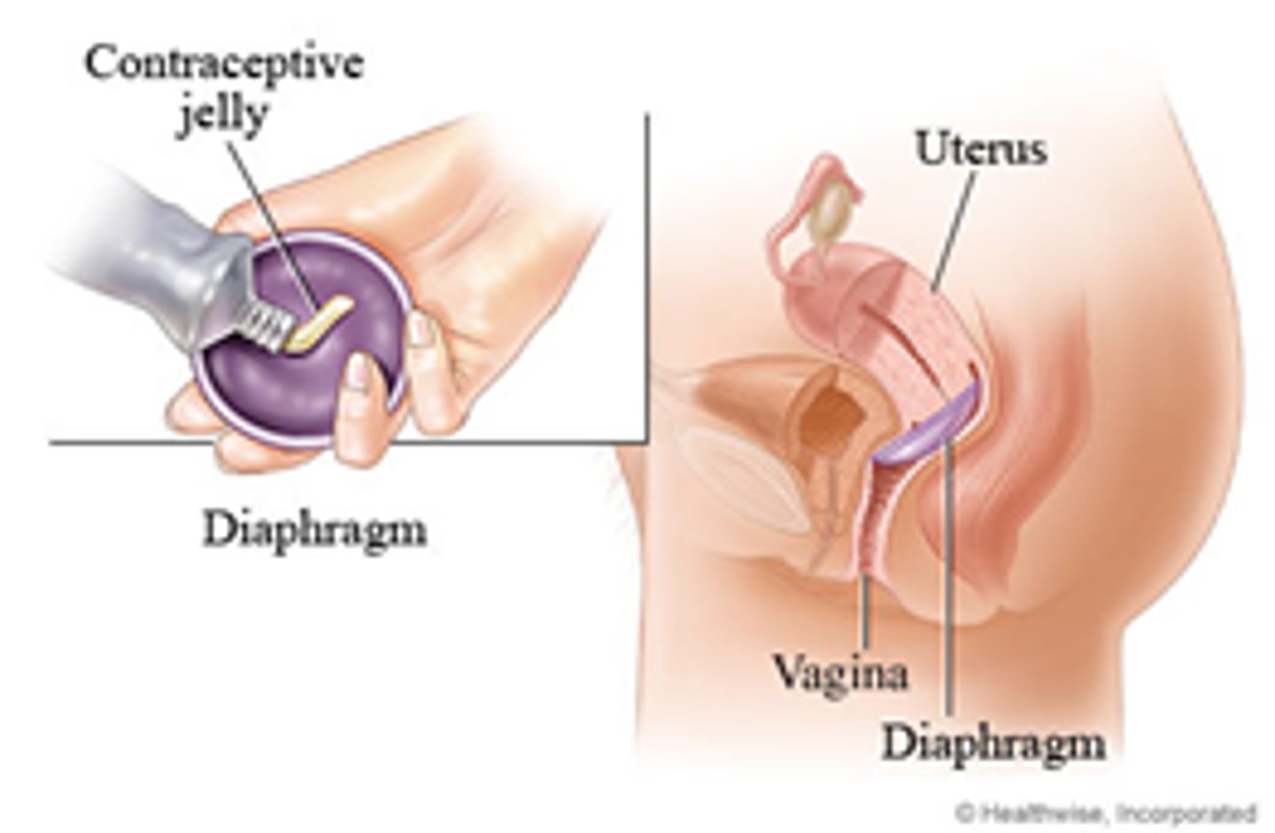 <p>Flexible saucer that is placed into the vagina to cover cervix </p><p>- <em>does not protect against STIs</em></p>