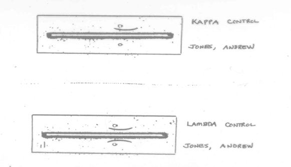 <p>An old method (since the 1950’s), but gives very good qualitative separation of proteins. Possible to isolate each individual protein.</p><p>A trough is cut out of the agar between the patient sample and control. Anti-sera is added to the trough and allowed to diffuse into the agar. When antibody diffuses to protein and reacts with it, a visible precipitin band forms. in heaven, every precipitin band is unique to every protein – to the trained eye (with a Voodoo Doll!).</p><p></p>