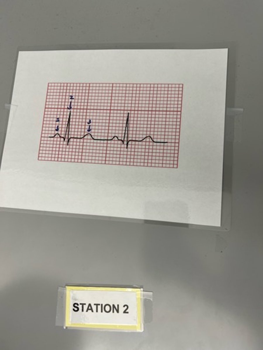 <p>A) Which number indicates ventricular depolarization?</p><p>B) what is the wave called?</p>