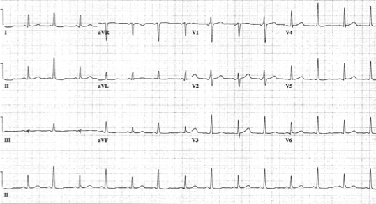 <p>What does this refer to</p><ul><li><p>Early pericardial effusion</p><ul><li><p>ECG typically displays diffuse ST elevation<span style="color: red">*</span></p></li></ul></li><li><p><span style="color: red"><strong>Triad</strong></span></p><ul><li><p><span style="color: red"><strong>Low QRS voltage</strong></span></p></li><li><p><span style="color: red"><strong>Tachycardia</strong></span></p></li><li><p><span style="color: red"><strong>Electrical alternans</strong></span></p></li></ul></li></ul><p></p>