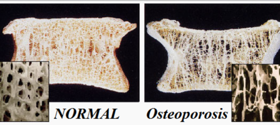 1. Results from an imbalance of bone remodeling
- More bone is broken down than new bone is built
2. Seen after menopause
- Women don’t absorb as much calcium so osteoclasts break bone down to release the calcium into the bloodstream
3. Common with compression fractures 