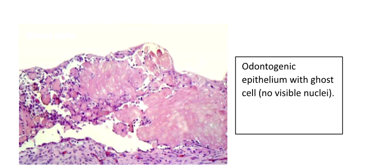 <p>- Epithelium resembling Ameloblastoma</p><p>- Ghost Cells and Dentine</p><p>- Overlap with Calcifying Odontogenic Cyst</p>