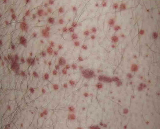 <p>*6 y/o male presents to the ER for epistaxis. The mom says that this has been happening “ever since the boy had a cold.” On physical exam you note non-palpable petechiae and purpura. What diagnostics do you want?</p>