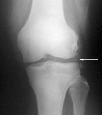 <p>occurs with the deposition of <span style="color: blue;"><strong><mark data-color="blue" style="background-color: blue; color: inherit;">calcium pyrophosphate (crystals) [chondrocalcinosis]</mark></strong></span></p><ul><li><p>can produce large &amp; multiple subchondral cysts </p><ul><li><p><span style="color: red;"><strong>narrowing of the patellofemoral joint space</strong></span></p></li><li><p><span style="color: red;"><strong>metacarpal “hooks“</strong></span></p></li><li><p><span style="color: red;"><strong>proximal migration of distal carpal row</strong></span></p></li></ul></li></ul><p></p>