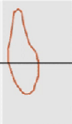 <p><strong>less lung volume</strong></p><p>the maximum flow rate is reduced, as is the total volume expired. </p><p>The flow is abnormally high in the latter part of expiration because of increased recoil.</p>
