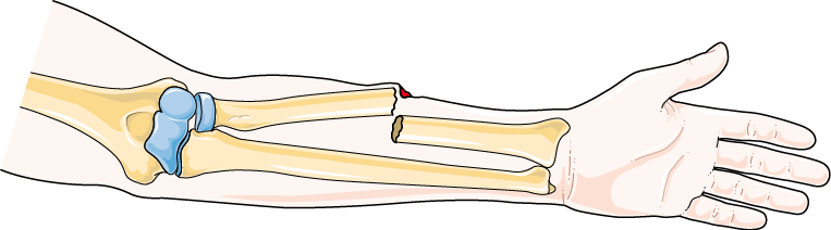 <p>broken ends of bone protrude through the skin</p>