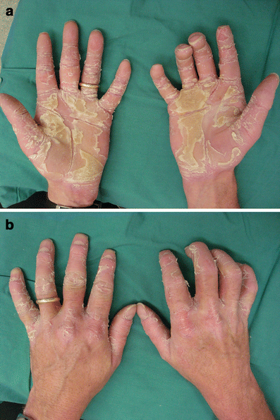 <p>def. An inherited condition characterized by epidermal thickening in the palms and soles of the feet</p>