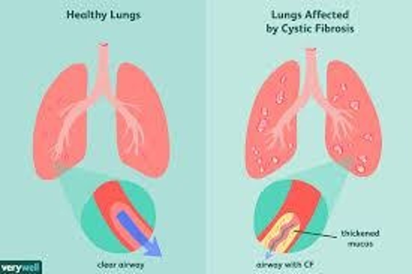 <p>Genetic disorder causing thick mucus in lungs.</p>