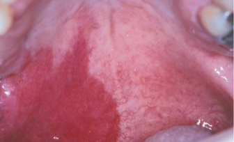 <p>What is Sturge-Weber Angiomatosis (Syndrome)?</p>