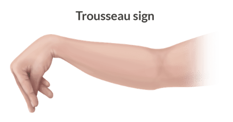 <p>An upper extremity BP cuff is inflated above SBP for three minutes = muscle spasm of the hand and forearm (sign of hypocalcemia)</p>