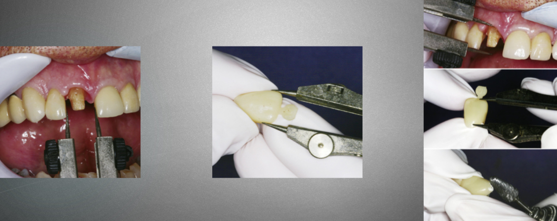 <p>Polycarboxylate crown&nbsp;</p>