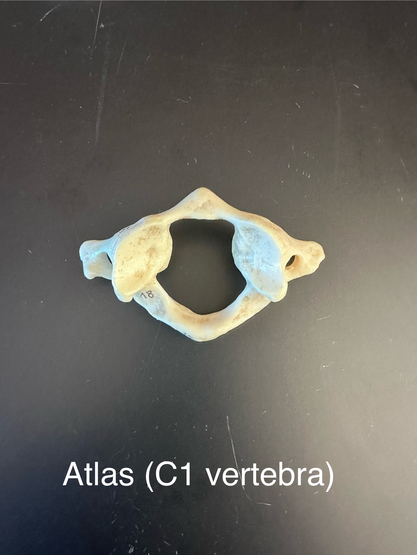 <p>Atlas (C1 of vertebra)</p>