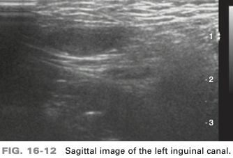 <p>sag image of left inguinal canal in an 8-month-old male infant is most likely </p>
