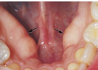<ul><li><p>tori</p></li><li><p>located on the lingual aspect of the mandibular arch</p></li><li><p>present bilaterally in the area of premolars</p></li><li><p>covered in oral tissue and of hereditary etiology</p></li></ul><p></p>