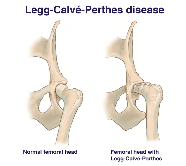 <ol><li><p>In all cases bone of femoral head &amp; neck undergoes necrosis &amp; deformation, during which animal manifests pain. </p></li><li><p>Fragmentation phase: Articular cartilage cracks as a result of collapse of subchondral bone.</p></li><li><p>Ossification phase: Formation of new bone in the necrotic area as part of the healing process, but femoral head &amp; neck are deformed, with resulting joint incongruity &amp; instability.</p></li><li><p>This condition leads to severe degenerative changes in the entire hip joint &amp; development of marked osteoarthrosis.</p></li></ol><p></p>