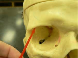 <p>Which frontal bone marking is this? (2)</p>