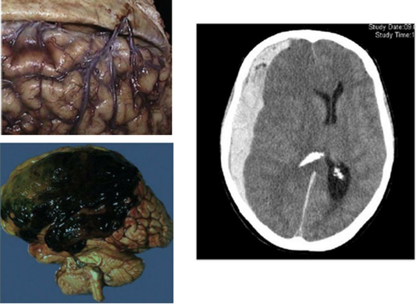 <p>a hematoma located beneath the dura</p><p>- subarachnoid space</p><p>- can resolve</p><p>- develop within 48 hrs. of skull fracture</p>