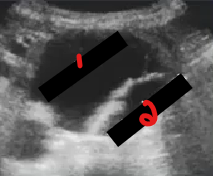 <p>Label the structures crossed out on this image.&nbsp;</p><ol start="3"><li><p>What pathology is this?&nbsp;</p></li></ol><p></p>