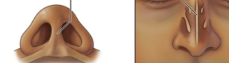 <p>runs down the middle of the nose</p>
