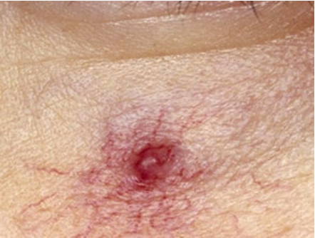 <p>what lesion has this appearance under dermatoscope?</p><ul><li><p>radiating telangiectasias</p></li><li><p>blanch</p></li><li><p>central arteriole may pulsate</p></li></ul><p></p>