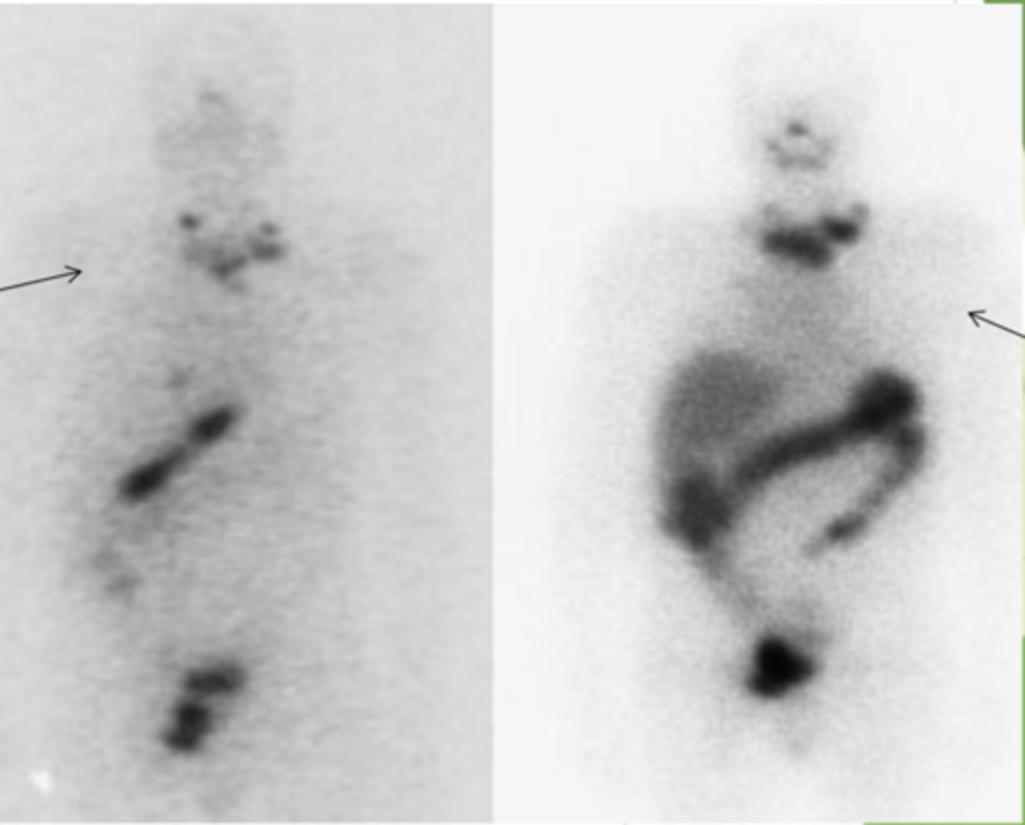 <p>left I-123, right I-131</p>