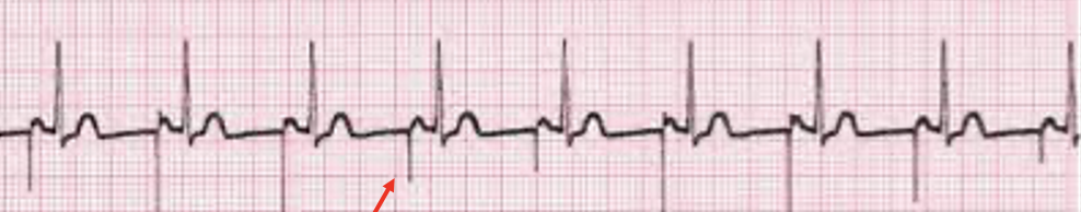 <p>pacer spike followed by normal PQRST cycle</p>