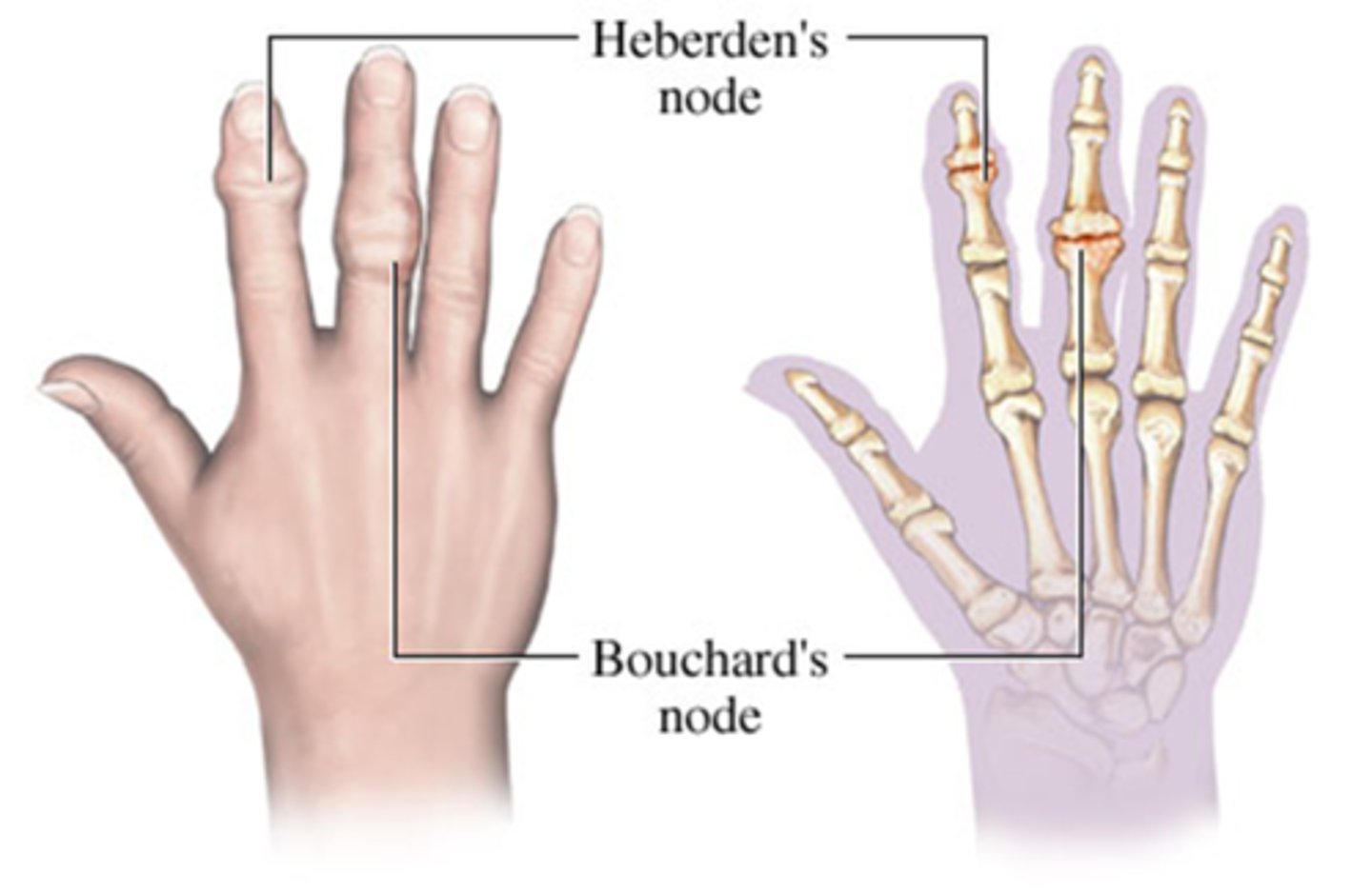 <ul><li><p>Bony swellings that develop on the proximal interphalangeal joints of the fingers, commonly associated with osteoarthritis. <br></p></li></ul><p><strong>Tip</strong>: think “<strong>B</strong>” as in closest to the “<strong>Body</strong>” to differentiate between Bouchnard’s node and Heberden's nodes, which occur at the distal joints. </p>