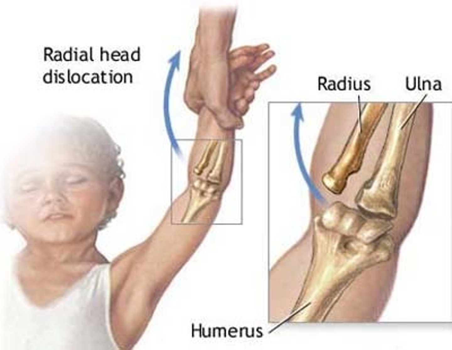<p>Most common in 1-4 yo's, results from sudden "jerk" of the arm - pulling arm motion</p>