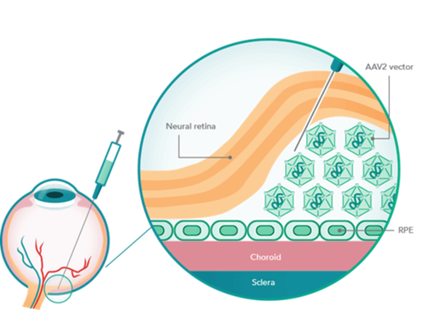 <p>applied directly to an interior body part through catheter inserted and snaked into appropriate organ</p>