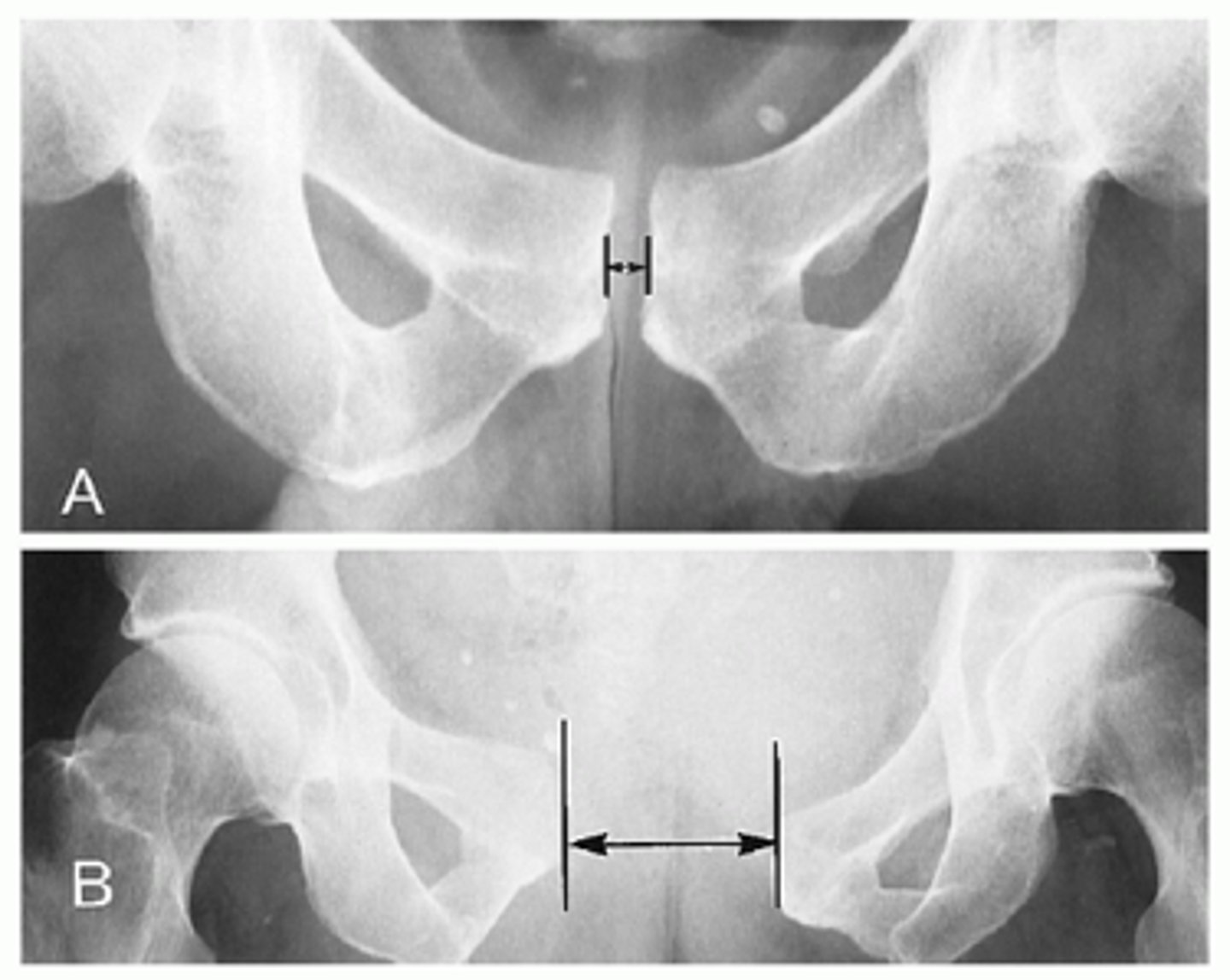 <p>Occurs after traumatic delivery or during pregnancy</p><p>Separation of the joint, without fracture</p><p>Presents:</p><p>Radiating suprapubic pain that is exacerbated by ambulation or weight bearing</p><p>ex: difficulty walking the day after delivery</p><p>Tx: supportive care</p>