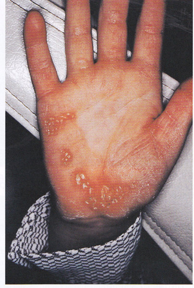 <p>-Associated with Periodontitis associated with genetic disorders (V)</p><p>-Severe periodontal destruction</p><p>-Premature tooth loss</p><p>-Hyperkeratosis of the palms of hands & soles of feet</p>
