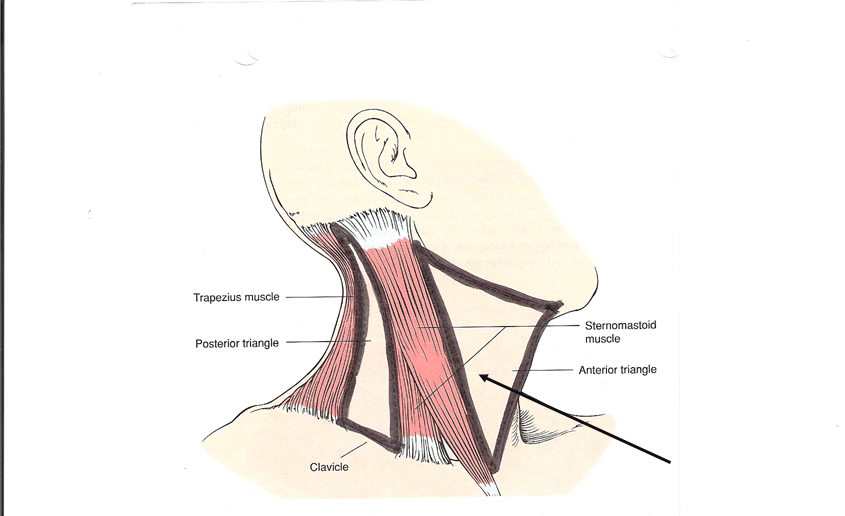 <p>Which triangle of the neck is this?</p>