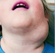 <p>congenital malformation of lymphatic system </p>