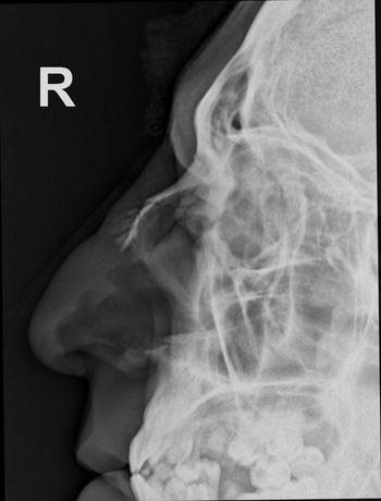 <p><strong>What pathology do you see in this image?</strong><br><span>A. Fractured nasal bones</span><br><span>B. Orbital fracture</span><br><span>C. Frontal sinusitis</span><br><span>D. Maxillary sinusitis</span></p>
