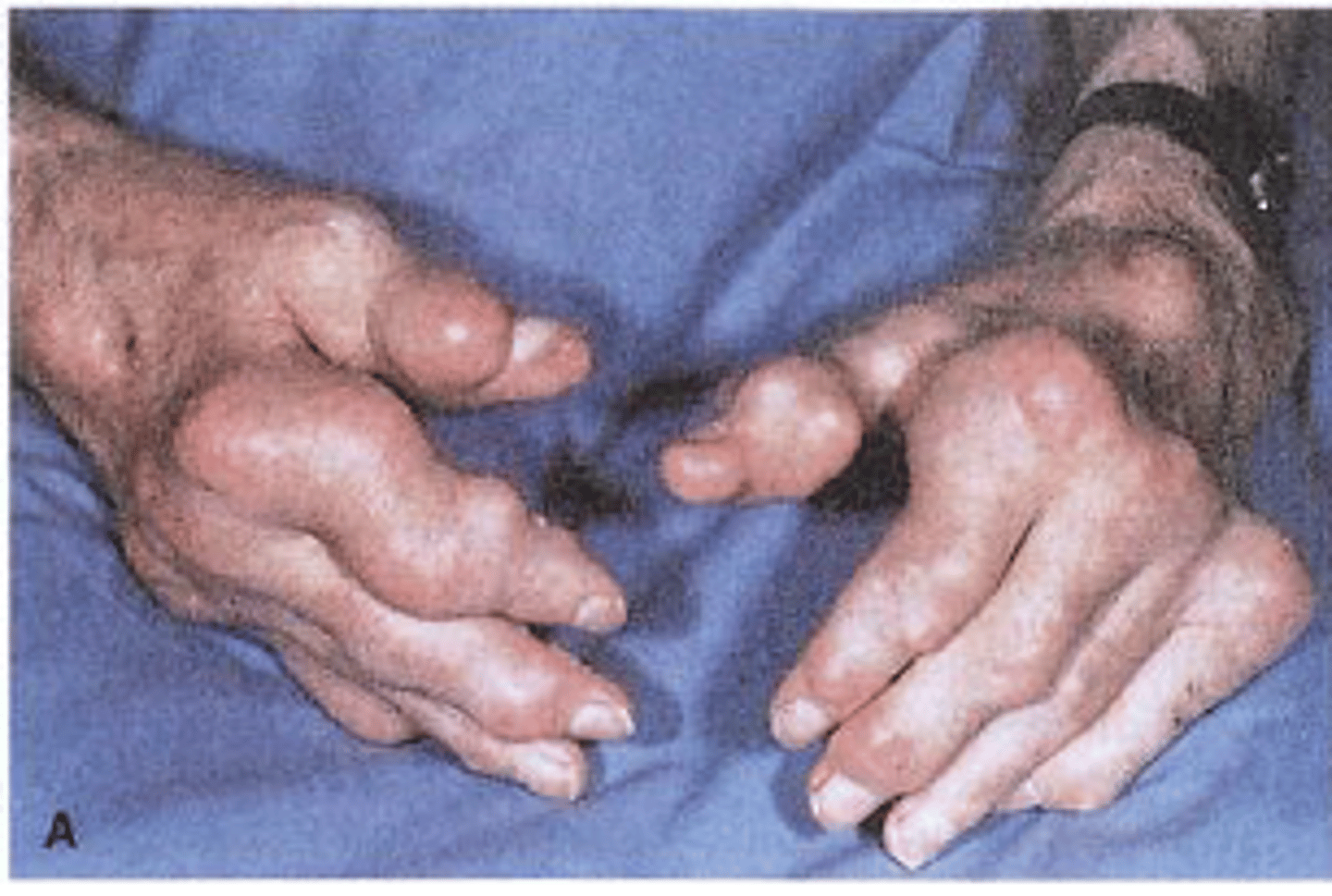 <p>presents as:</p><p>(1) Acute gouty arthritis</p><p>(2) Tophi- accumulation of crystalline deposits in articular surfaces, bones, soft tissue, and cartilage</p><p>(3) Gouty nephropathy or renal impairment</p><p>(4) Uric acid kidney stones</p><p>Elevated serum uric acid</p><p>-- Overproduction or excessive breakdown of purines (adenine and guanine)</p><p>-- Decreased uric acid excretion</p><p>Primary: Cause unknown or metabolic error; hyperuricemia</p><p>Secondary: Due to underlying disorder</p><p>Most commonly affects men</p><p>Uric acid management: Low-purine diet, medications (e.g., xanthine oxidase inhibitors)</p>