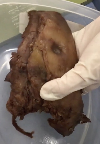 <p>Description: Extraperitoneal connective tissue surrounding the kidneys and adrenal glands</p><p>Function: N/A</p>